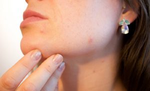 astuce acne naturelle