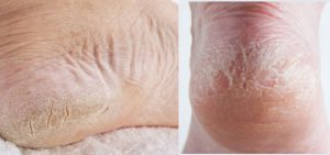 pieds crevasses