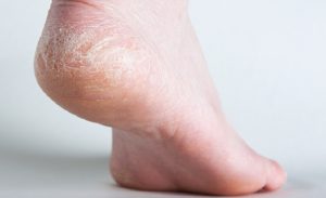 pieds fendilles