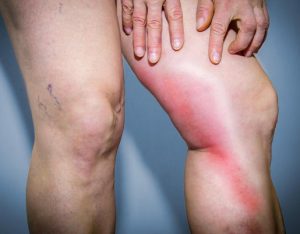 astuce sante symptome thrombose veineuse jambe rougeur