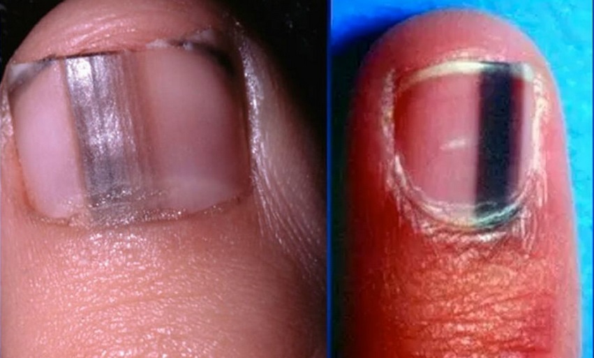 Taches Sur L ongle Lignes De Beau Sur Les Ongles OG Artland Taches Sur L ongle Lignes De Beau Sur Les Ongles OG Artland