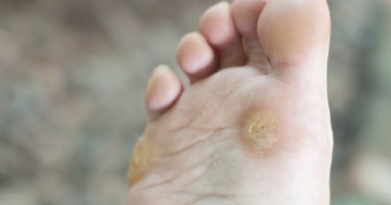 Éliminez Les Cors Au Pied & Les Verrues Avec Ces 4 Astuces De Grand